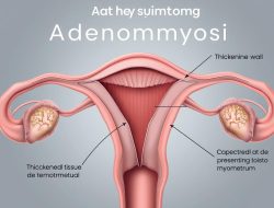 Memahami Penyakit Adenomiosis: Gejala, Penyebab, dan Pengobatan