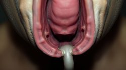 Mengenal Penyakit Akalasia: Gejala dan Penanganannya